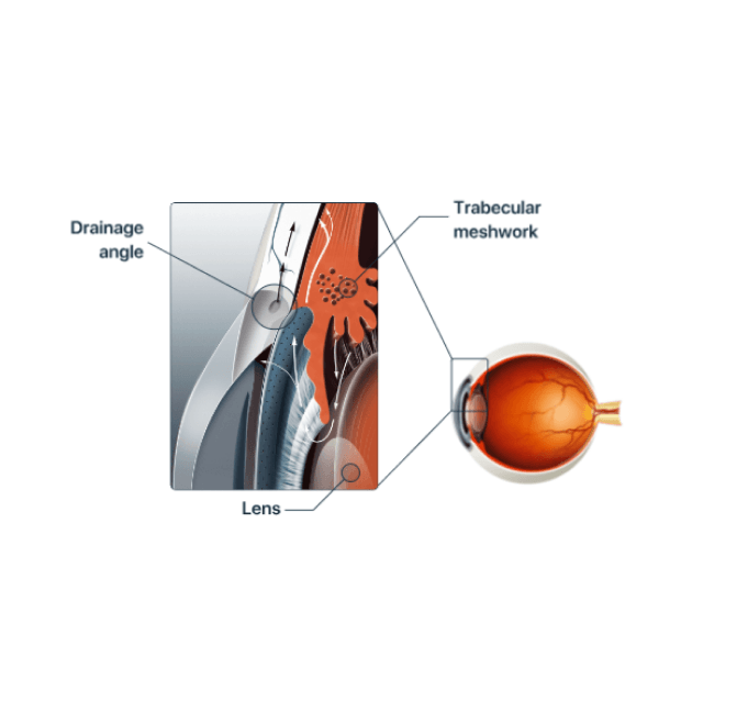 Glaucoma trabeculectomy