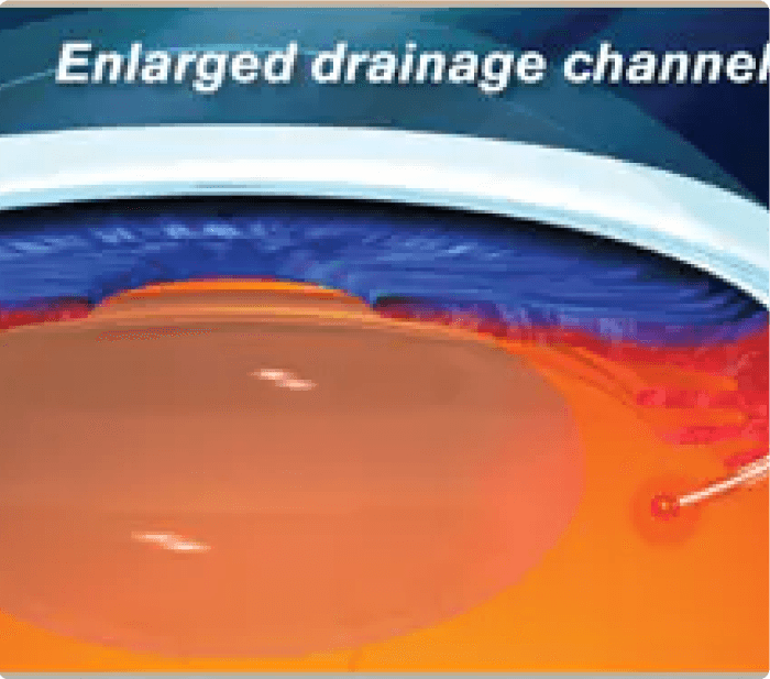 Glaucoma canaloplasty 