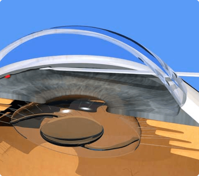 Glaucoma eye surgery