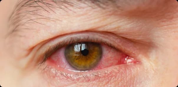 Allergic Conjunctivitis
