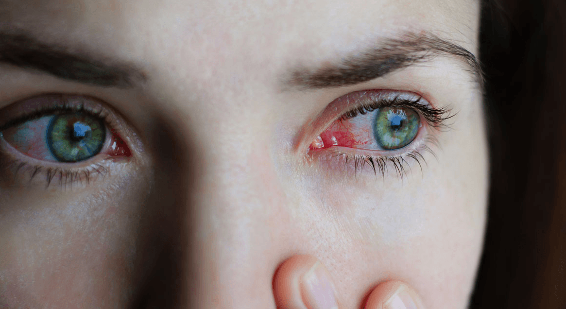 Red Eyes