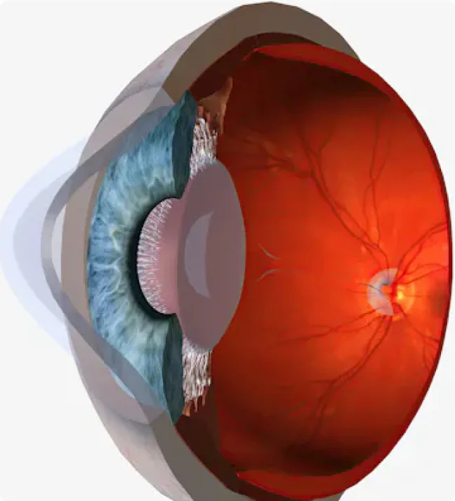 Lamellar Corneal Graft  